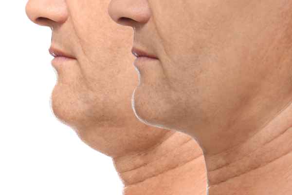 HIFU - Breakthrough in Anti - ageing 2 hifu results Oxfordshire