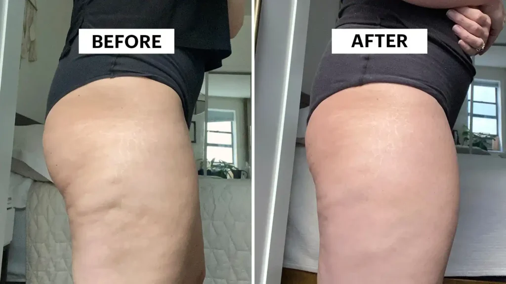Sculpting Your Bum: Can Toning Exercises Really Reduce Cellulite? 1 Do Toning Exercise Oxfordshire Really Tackle Cellulite?