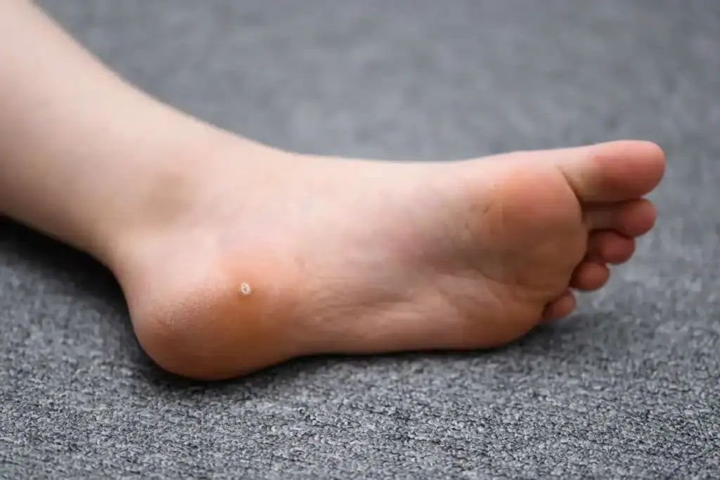 Cryotherapy For Warts And Also Verrucas 2 Image of verruca on the bottom of the foot that able to be treated with Cryotherapy Oxfordshire