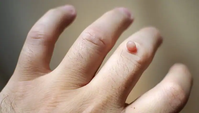 Cryotherapy For Warts And Also Verrucas 1 Image of blemish that Cryotherapy Oxfordshire can remove with Lipo 360.