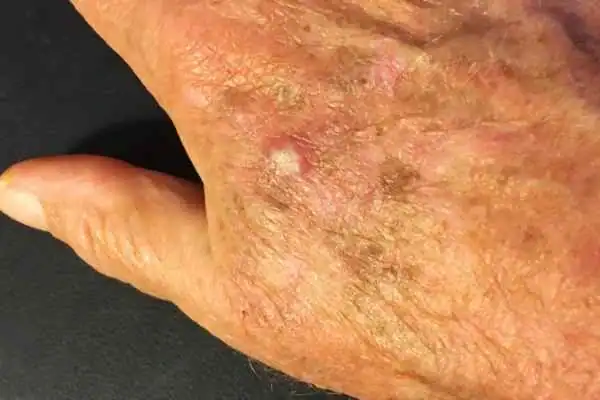 Cryopen For Actinic Keratoses 1 Image of Actinic keratoses Oxfordshire on a person hand