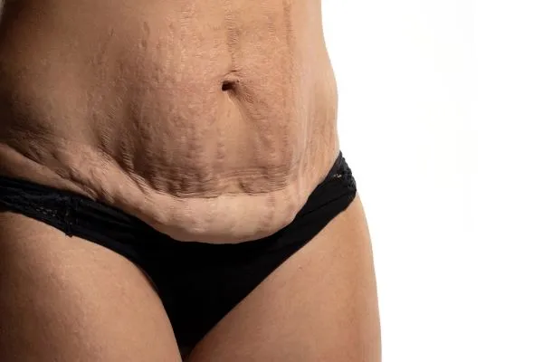 The science behind skin tightening Oxfordshire picture of a woman's sagging skin on the stomach